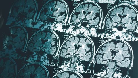 Resonancia magntica para detectar el alzhimer