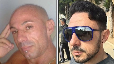 Antes y después de un trasplante capilar