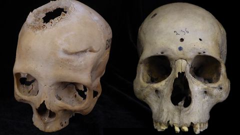 A la izquierda, el cráneo de una mujer egipcia a la que se le realizó una cirugía por un cáncer de huesos que le dejó una lesión en el cerebro de más de 10 centímetros. A la derecha, el cráneo de un hombre al que se le intervino por un tumor nasofaríngeo que se extendió al cerebro