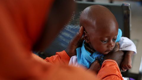 Un bebé con malnutrición recibe tratamiento en un centro de atención primaria de Nigeria