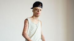 Aleixo Paz, protagonista del documental �El ni�o de fuego�, una gran historia de superaci�n