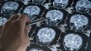 Radiograf�a para identificar el alzh�imer