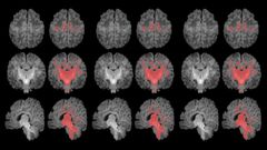 Un estudio mide con resonancia magntica la mielinizacin cerebral de los recin nacidos