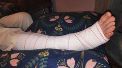 El pie de David Puertas, tal y como se lo han vendado en Cabueñes