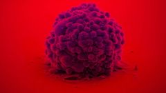 Imagen de un glioblastoma, el tumor cerebral m�s agresivo