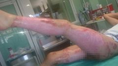 Un trabajador del tanatorio sufri� unas grav�simas quemaduras que lo tuvieron varios meses hospitalizado tras prenderse fuego mientras limpiaba una furgoneta.