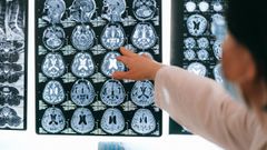 Imagen de archivo de resonancias magnticas del cerebro