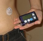 Una bomba de insulina est�ndar. 