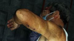 El hombre muestra las heridas que sufri� en uno de los brazos