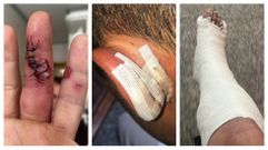 Lesiones sufridas por algunas de las v�ctimas de la agresi�n en las fiestas de Vilaboa.
