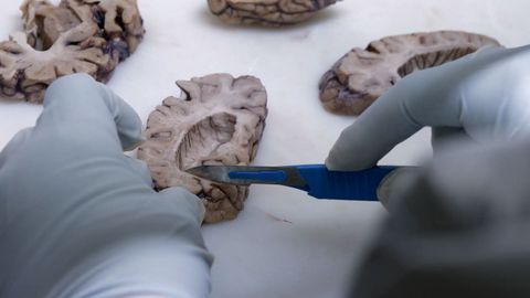 Varias l�minas de un cerebro donado.