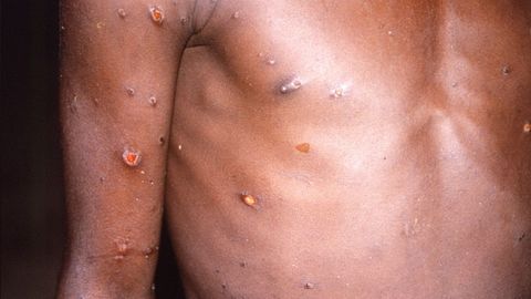 Uno de los sntomas de la viruela del mono son las erupciones en la piel