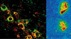 Neuronas afectadas, a la izquierda, y reducci�n progresiva de la prote�na clave en la enfermedad tras el tratamiento (derecha)