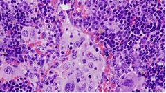 Imagen de microscop�a de un bazo que presenta un linfoma desarrollado por ratones que expresan una mutaci�n oncog�nica en el gen VAV1