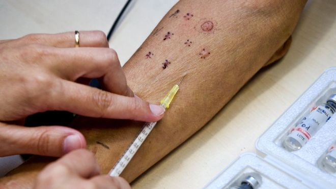 Imagen de archivo de una prueba de alergia. 