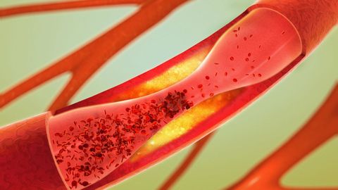 La acumulaci�n de placas de colesterol endurecidas dentro de las arterias produce el estrechamiento que da lugar a enfermedades cardiovasculares