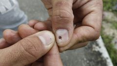 Imagen de una garrapata en las u�as de un hombre durante otra plaga del a�o 2017