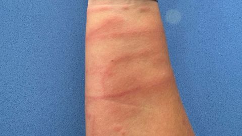 Un afectado, con la marca de los largos filamentos de las carabelas en su brazo