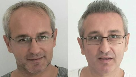 Antes y después de un trasplante capilar
