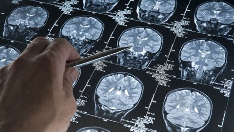 Imagen de archivo de una tomografa cerebral