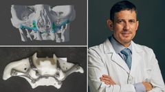 Arriba a la izquierda la prtesis maxilar en su simulacin virtual y debajo, impresa en 3D en titanio mdico. A la derecha, el cirujano Pedro Martnez Seijas