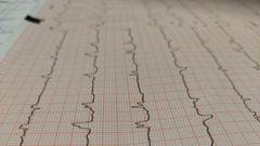 Imagen de archivo de un electrocardiograma.