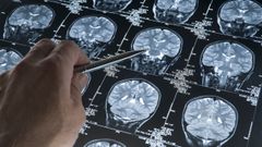 Radiograf�a para identificar el alzh�imer