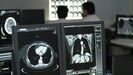 Imagen de archivo de un tac pulmonar