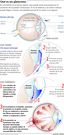 Qu� es un glaucoma