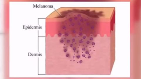 Las 5 pistas que te alertan de un posible melanoma