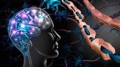 Infografa de un cerebro humano con esclersis mltiple.