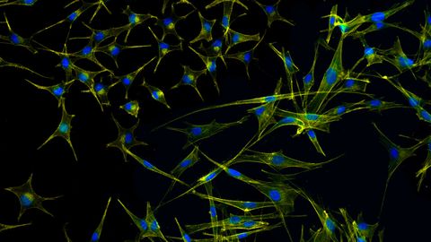Un nuevo avance en la lucha contra el melanoma