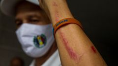 Uno de los opositores venezolanos, de Accin Democrtica, muestra sus heridas tras las protestas de este lunes