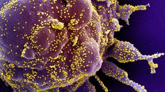 Part�culas del virus, en amarillo, infectando a una c�lula en una imagen tomada por microscop�a