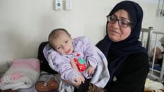 Un nio palestino, que sufre desnutricin, recibe atencin mdica en el hospital Kamal Adwan en el norte de la Franja de Gaza, en medio del hambre generalizada, durante el actual conflicto entre Israel y Hams