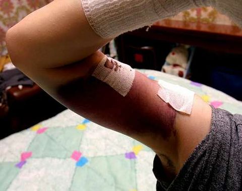 El 43 % de las agresiones afectan a los miembros superiores.