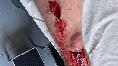 Heridas en la pierna del joven atacado por un jabal� en Proaza