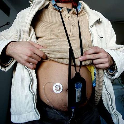 Ejemplo de una bomba de insulina instalada en un paciente.