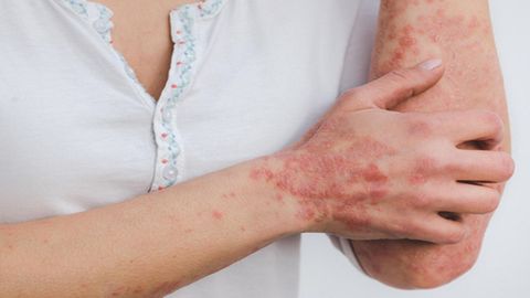 Paciente con psoriasis en el brazo