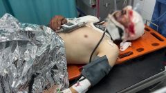 Un periodista de Al Jazeera despu�s de perder su pierna en un ataque de dron de Israel sobre Gaza