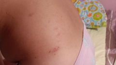 En la fotograf�a, las picaduras de uno de los alumnos del centro educativo.