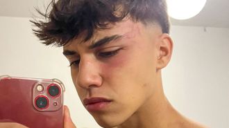 El joven pontevedrs que present la denuncia, con las marcas en la cara de los golpes que asegura que le dieron los porteros del Dux.