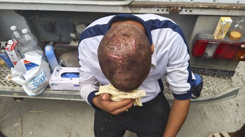 Imagen publicada por Amnist�a Internacional que muestra las heridas en la cabeza de un inmigrante en Ceut�