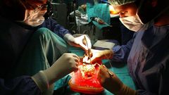 OPERACI�N DE TRANSPLANTE DE RI��N EN EL CHUAC