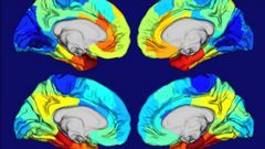 Im�genes cerebrales que muestran los ovillos de la prote�na tau implicada en el alzh�imer