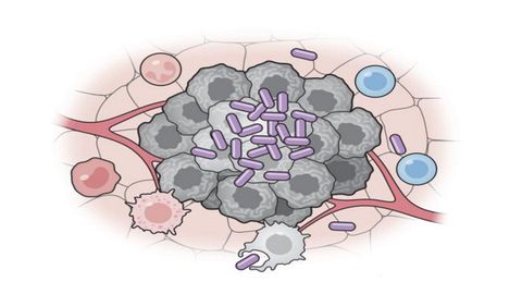 Clulas bacterianas artificiales (prpura) activan varias partes del sistema inmunitario para atacar a las clulas tumorales (gris).