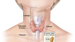 C�ncer de tiroides