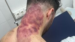 Estado en el que tiene �scar el cuello tras la paliza