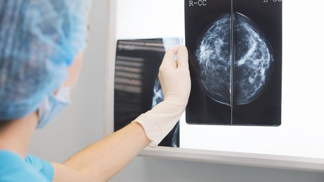 Resultado de una mamograf�a. 