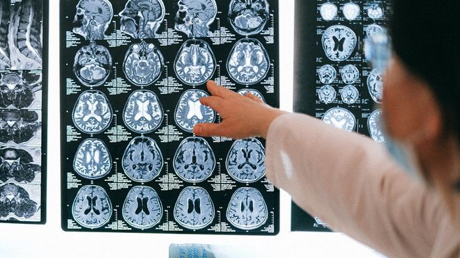 Imagen de archivo de resonancias magn�ticas del cerebro